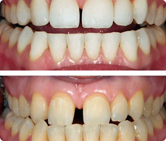 2. ravni zobje