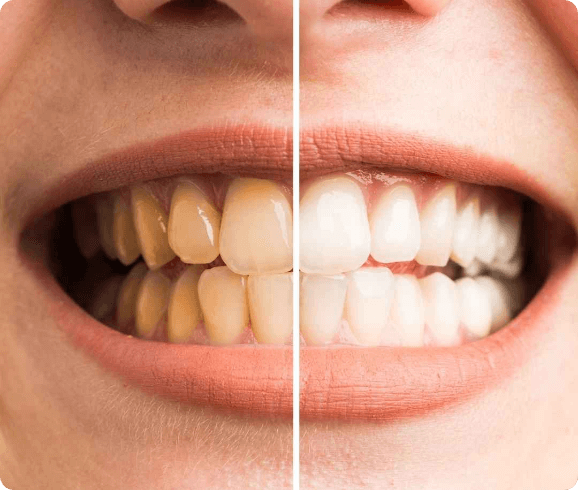 Lasersko beljenje zob